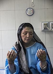 Victima unui atac cu acid este tratată la spital, în Teheran, 2018.  