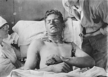 Canadian soldier with moderate mustard gas burns
