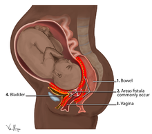Plaatsen waar obstetrische fistels voorkomen  