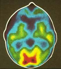 O "felie" a unei scanări PET, cu o regiune de interes evidențiată.