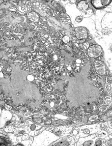 Rabies viruses in a cell, EM. Clearly visible are the Negri bodies.