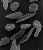 Červené krvinky v tvare kosáčikov. Tento nesmrteľný stav sa u heterozygotov udržiava vďaka vyrovnávajúcej selekcii u ľudí v Afrike a Indii vďaka ich odolnosti voči malarickému parazitovi.