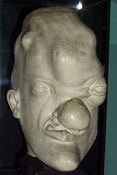Socha osoby s terciárnym (gummatóznym) syfilisom v Musée de l'Homme v Paríži.
