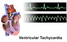 Électrocardiogramme normal (en haut) et électrocardiogramme de la tachycardie ventriculaire (en bas)